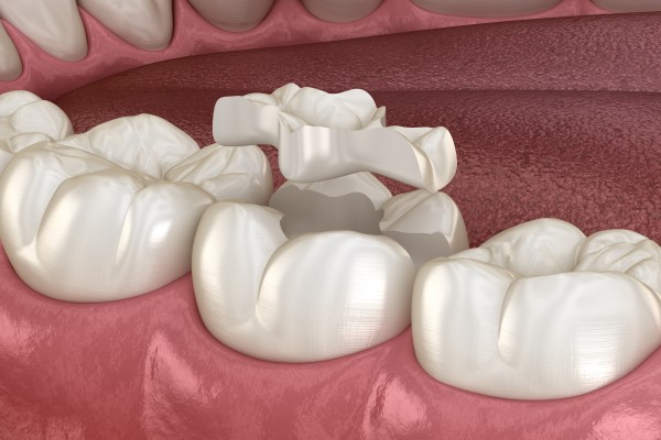 A Step By Step Guide To Getting A Dental Inlay